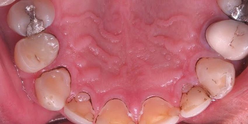 عاج دندان چیست
