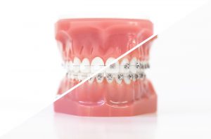 مقایسه ارتودنسی سرامیکی و فلزی