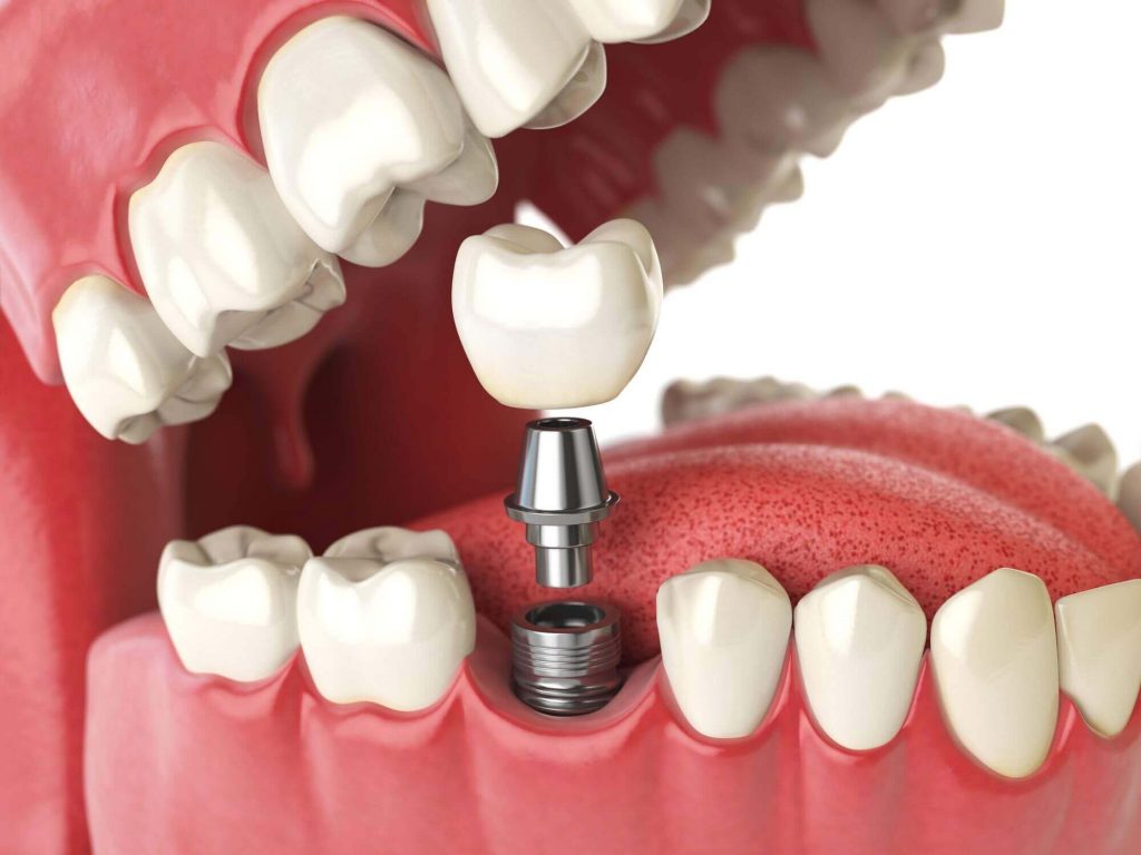 مراحل درمانی ایمپلنت دندان‌ها