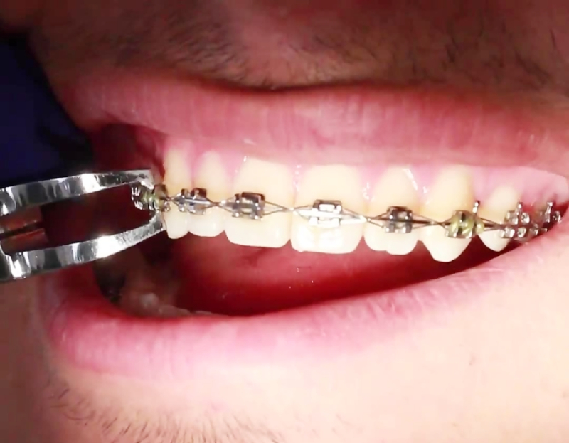 اتمام درمان ارتودنسی دندان