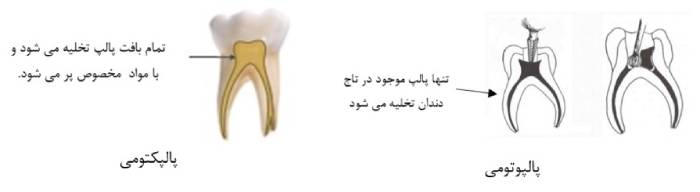 درمان پالپوتومی و پالپکتومی دندان