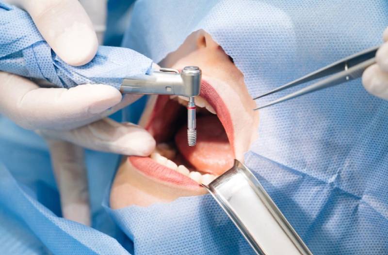 ایمپلنت دندان با جراحی دهان و دندان