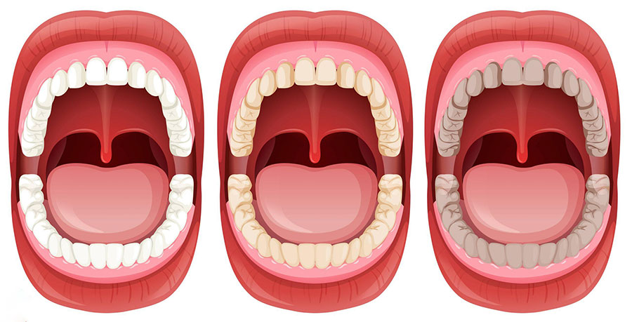 علل زرد شدن دندان