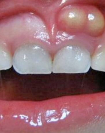 تروما دندان چیست