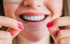 سفید کردن دندان با نوار کلینیک دندانپزشکی دکتر محمود دلنوا