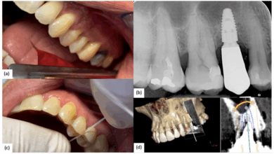 ایمپلنت لیزری دندان چیست؟ مراحل، مزایا، معایب و مراقبت های بعد از آن