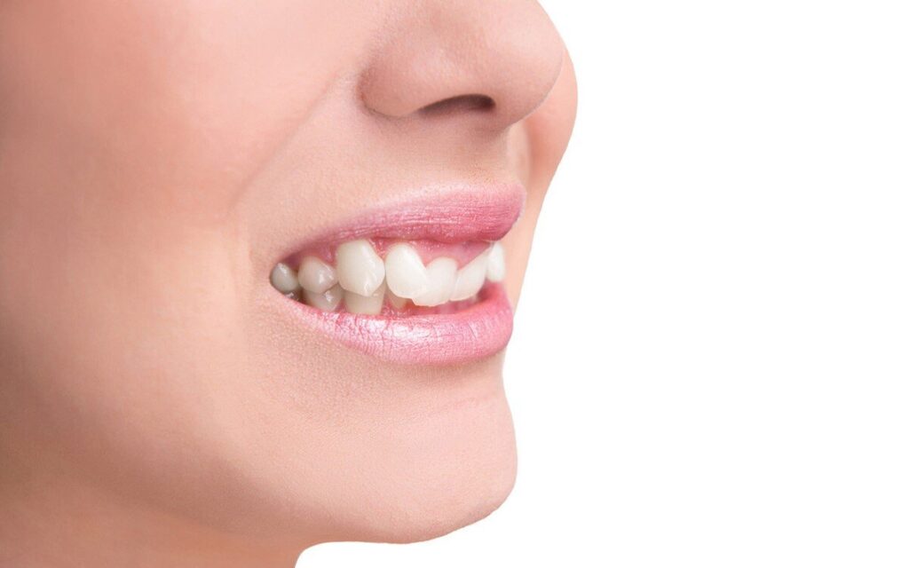 روش های ارتودنسی دندان جلو