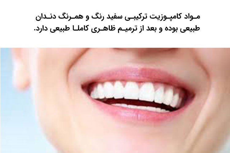 کامپوزیت بهترین مواد دندانپزشکی برای ترمیم دندان