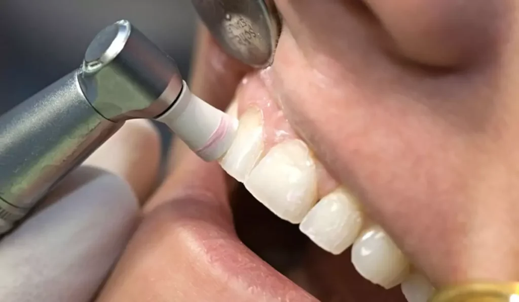 بروساژ دندان چگونه انجام می‌شود؟