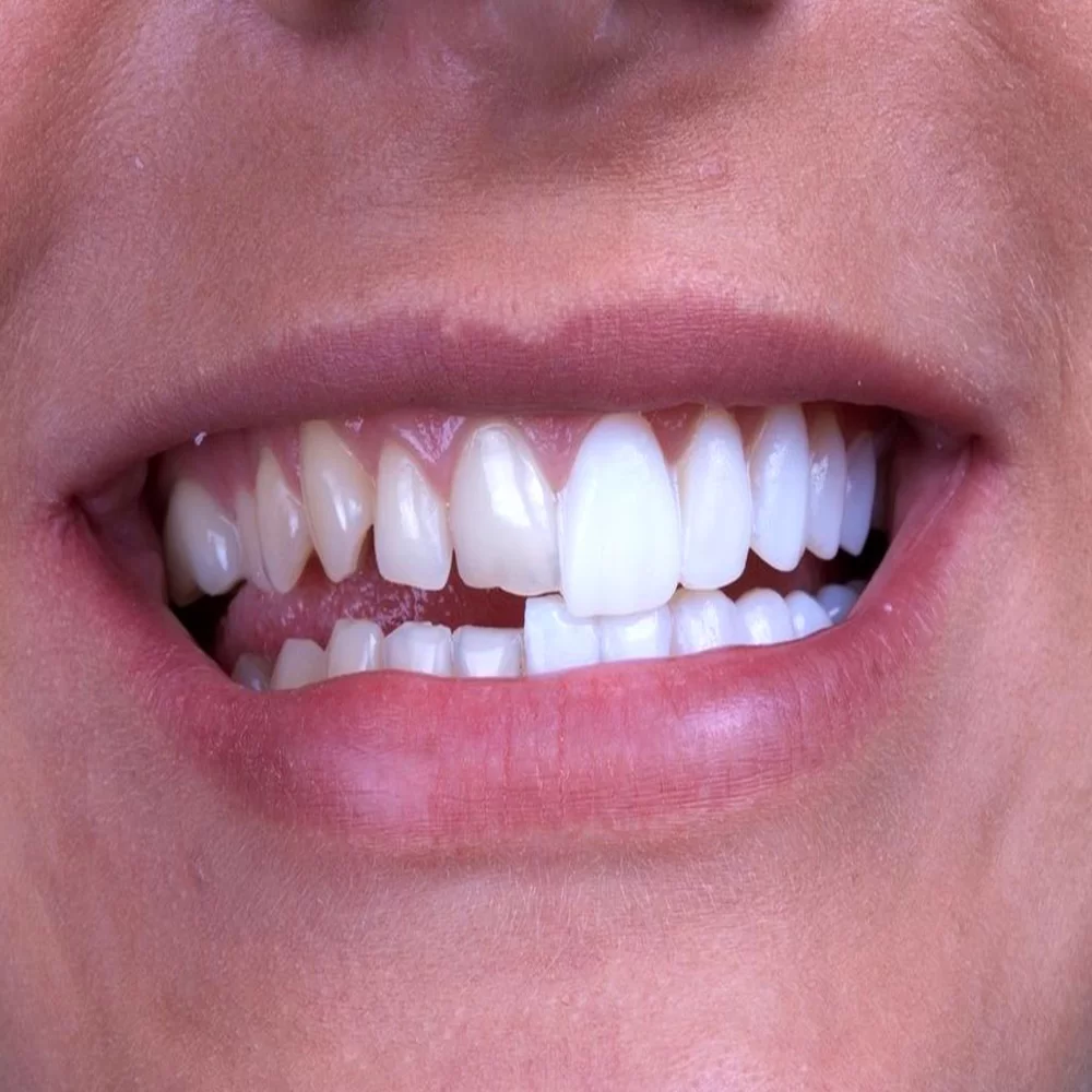 آیا لومینیرزها باعث تخریب دندان‌های شما می‌شوند؟