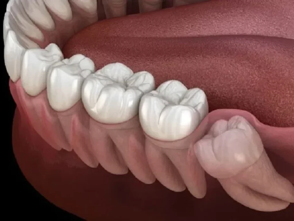 مدت زمان درد دندان عقل