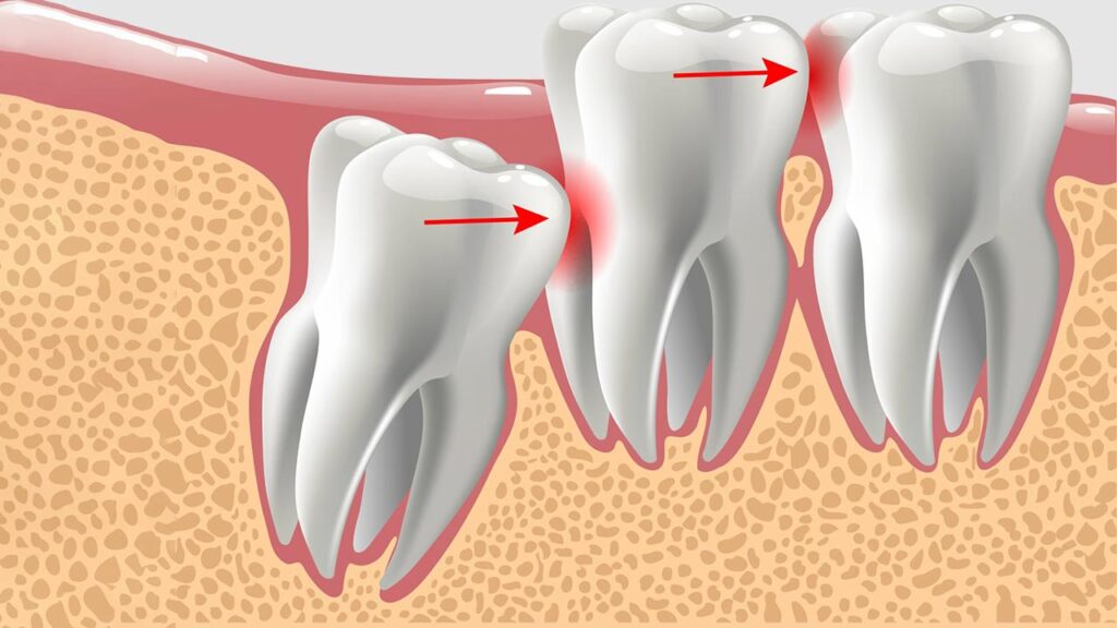 علل درد در هنگام کشیدن دندان عقل: