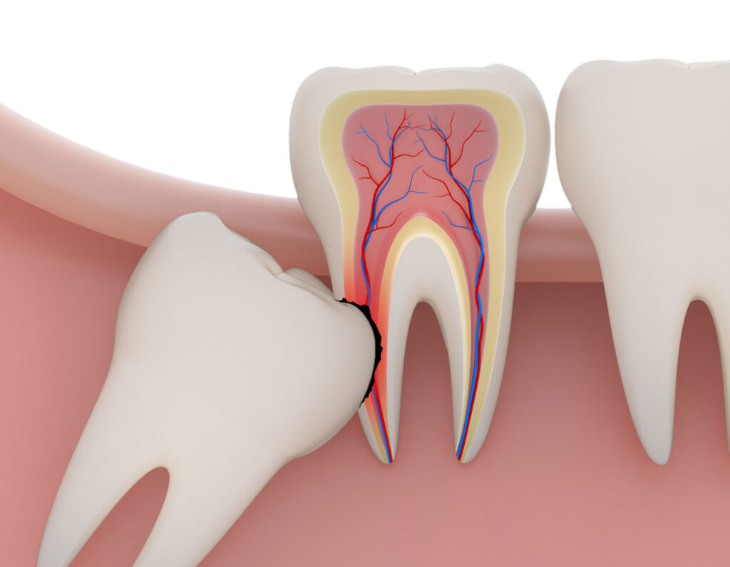 عوارض کشیدن دندان عقل پایین
