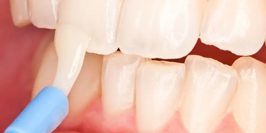 مراحل انجام فیشور سیلانت چگونه است؟