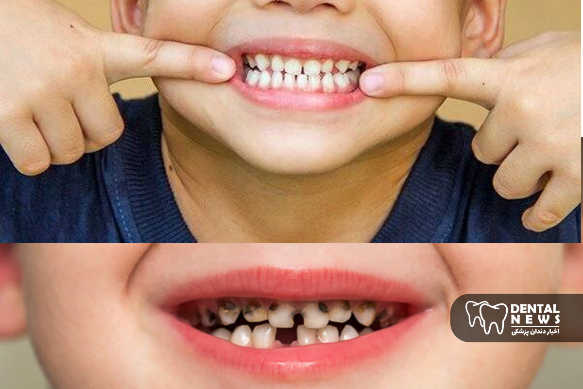 علائم پوسیدگی دندان شیری در کودکان