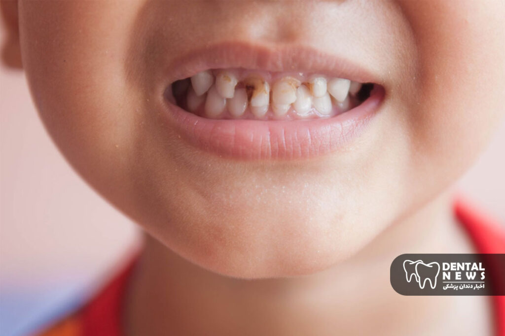 علائم پوسیدگی دندان شیری در کودکان