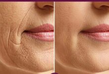 برسی هایفوتراپی صورت صفر تا 100