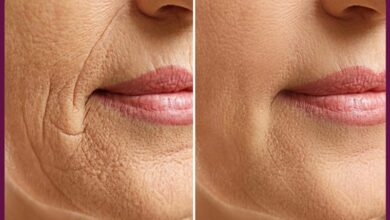 برسی هایفوتراپی صورت صفر تا 100