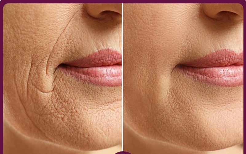 برسی هایفوتراپی صورت صفر تا 100