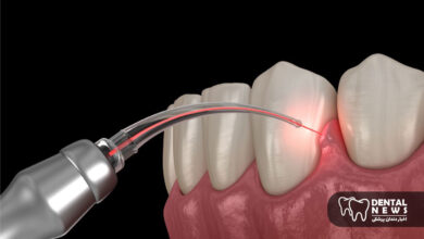 تاثیر لیزر کمتوان بر افزایش ترمیم لثه