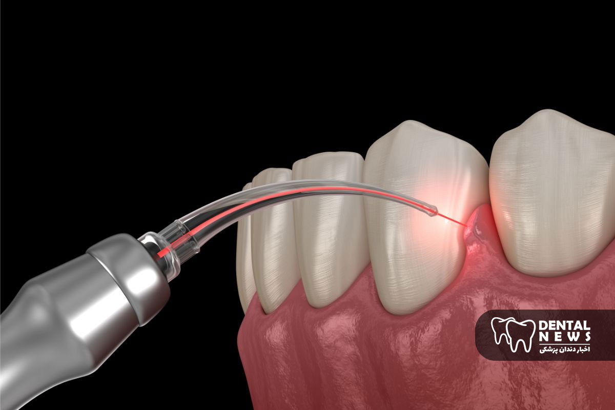 تاثیر لیزر کمتوان بر افزایش ترمیم لثه