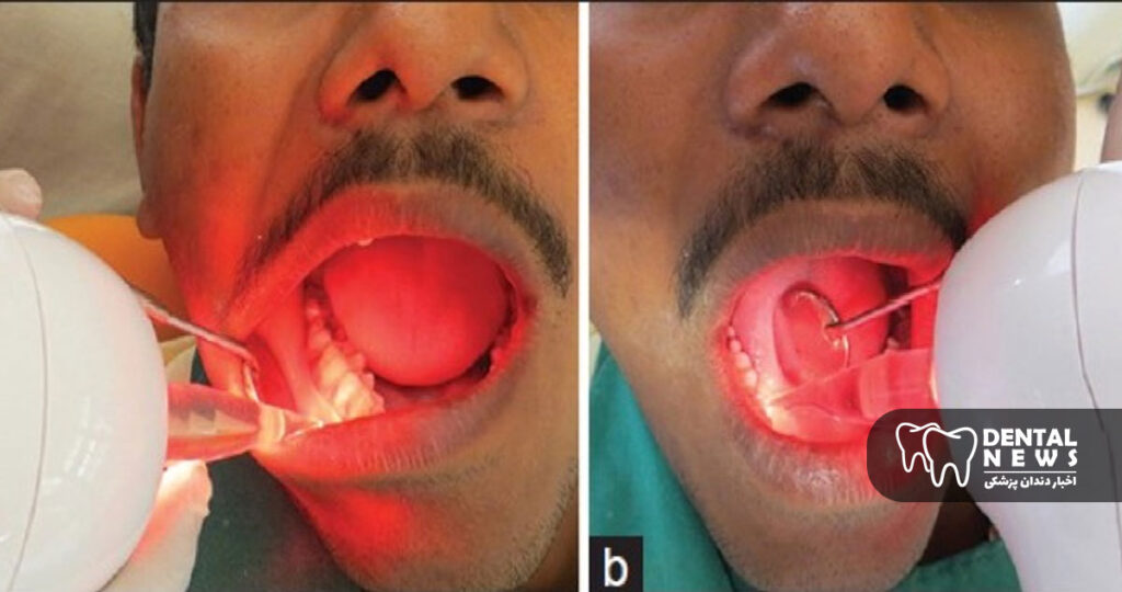اثر لیزر بر ترمیم لثه