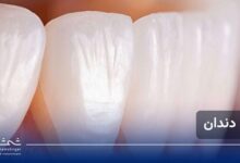 همه چیز درباره لمینت دندان؛ روش انجام، ماندگاری و نکات طلایی مراقبت بعد از لمینت