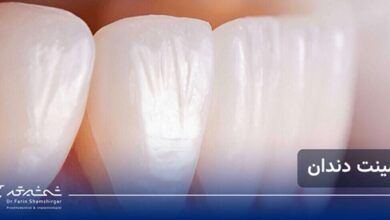 همه چیز درباره لمینت دندان؛ روش انجام، ماندگاری و نکات طلایی مراقبت بعد از لمینت