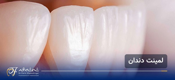همه چیز درباره لمینت دندان؛ روش انجام، ماندگاری و نکات طلایی مراقبت بعد از لمینت