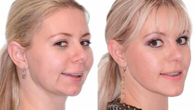 چرا دندان ها در ارتودنسی حرکت نمیکنند