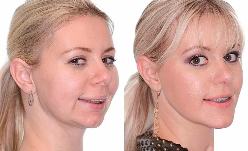 چرا دندان ها در ارتودنسی حرکت نمیکنند