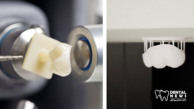 فناوری جدید در ساخت ترمیم های زیرکونیای چاپ سه بعدی در همان روز