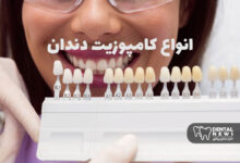 انواع کامپوزیت دندان: میکرو، نانو، هیبریدی + مزایا و معایب هرکدام