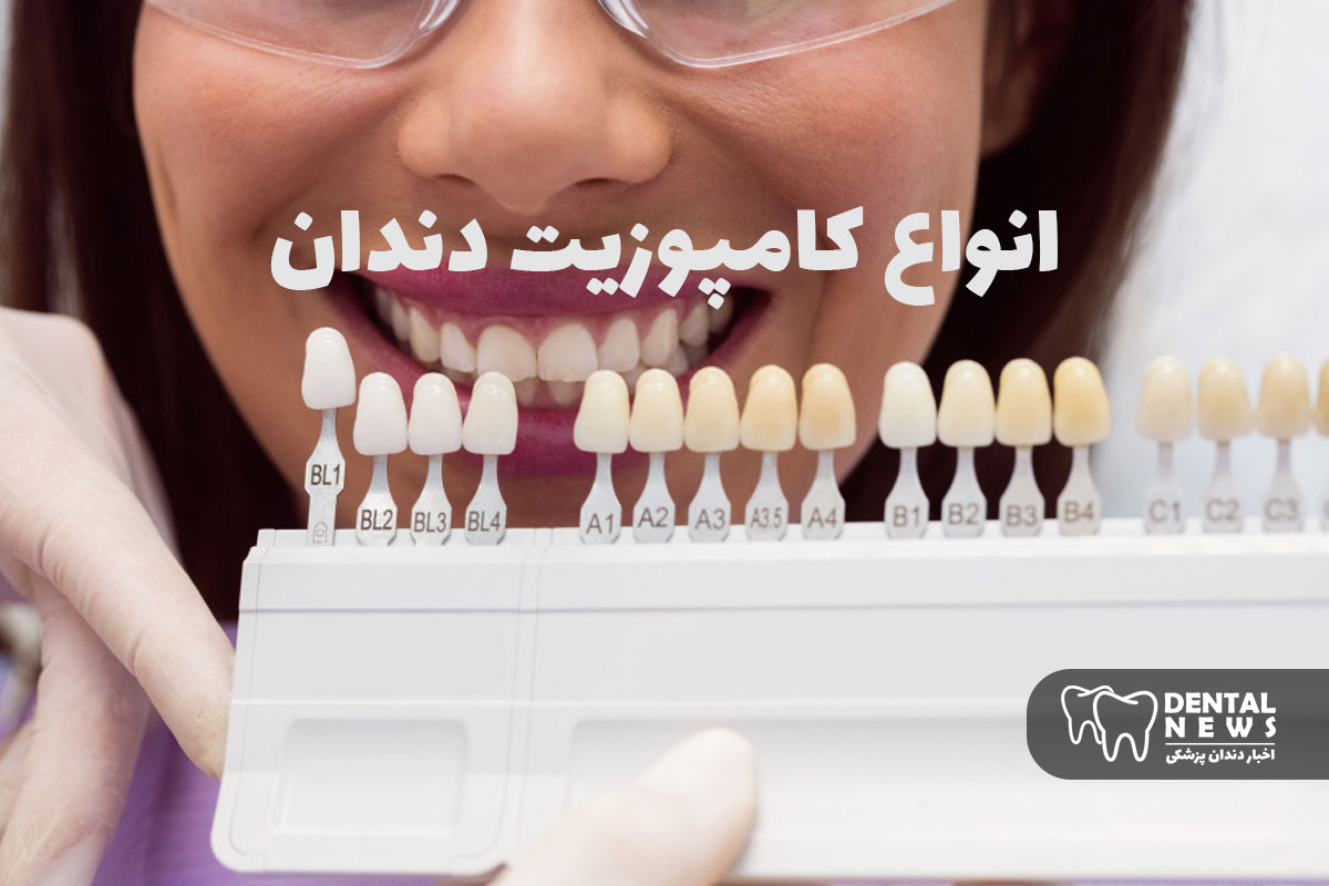 انواع کامپوزیت دندان: میکرو، نانو، هیبریدی + مزایا و معایب هرکدام