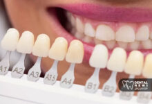 مراقبت بعد از کامپوزیت: نکات طلایی برای جلوگیری از تغییر رنگ و شکستگی