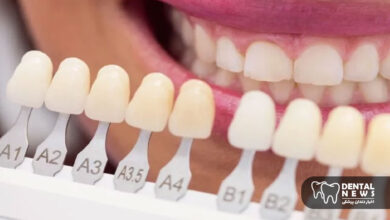 مراقبت بعد از کامپوزیت: نکات طلایی برای جلوگیری از تغییر رنگ و شکستگی