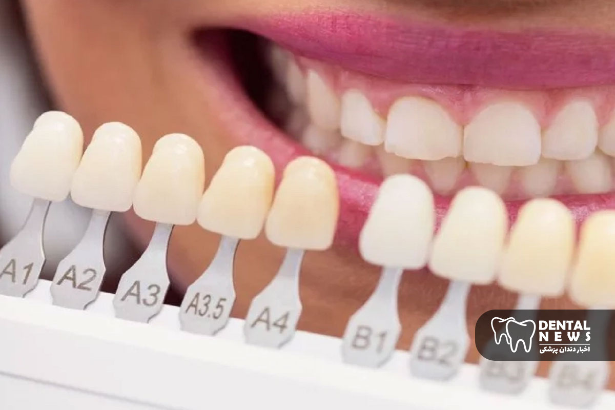 مراقبت بعد از کامپوزیت: نکات طلایی برای جلوگیری از تغییر رنگ و شکستگی