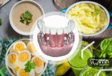 رژیم غذایی بعد از ایمپلنت دندان؛ چه بخوریم و چه نخوریم؟