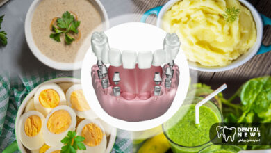 رژیم غذایی بعد از ایمپلنت دندان؛ چه بخوریم و چه نخوریم؟