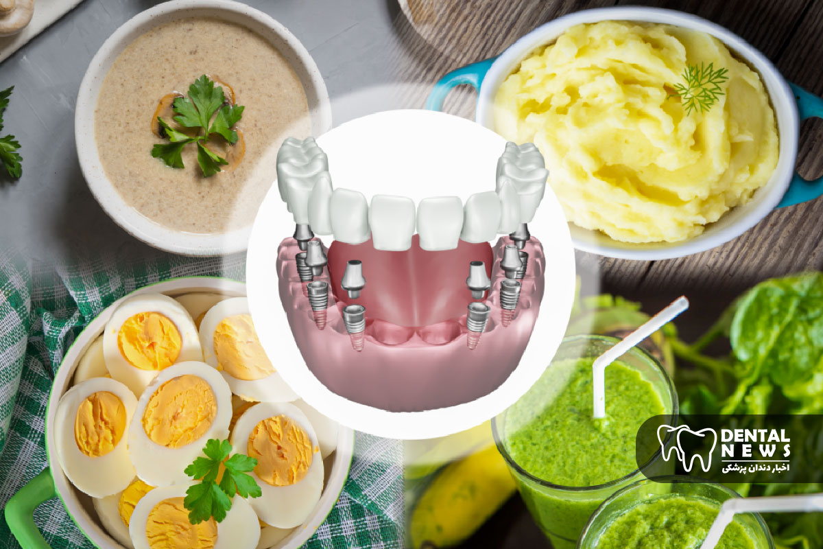 رژیم غذایی بعد از ایمپلنت دندان؛ چه بخوریم و چه نخوریم؟