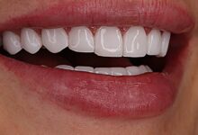 لمینت دندان چقدر ماندگاری دارد؟ + نکاتی برای افزایش طول عمر آن