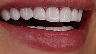 لمینت دندان چقدر ماندگاری دارد؟ + نکاتی برای افزایش طول عمر آن