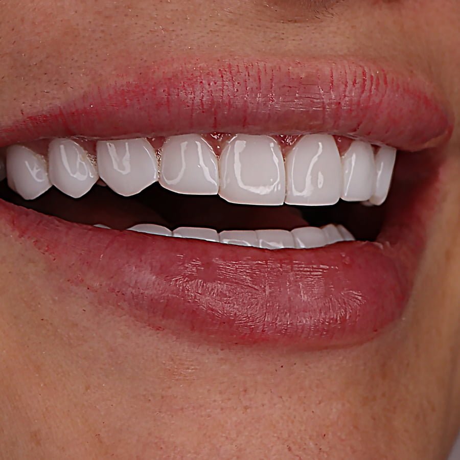 لمینت دندان چقدر ماندگاری دارد؟ + نکاتی برای افزایش طول عمر آن