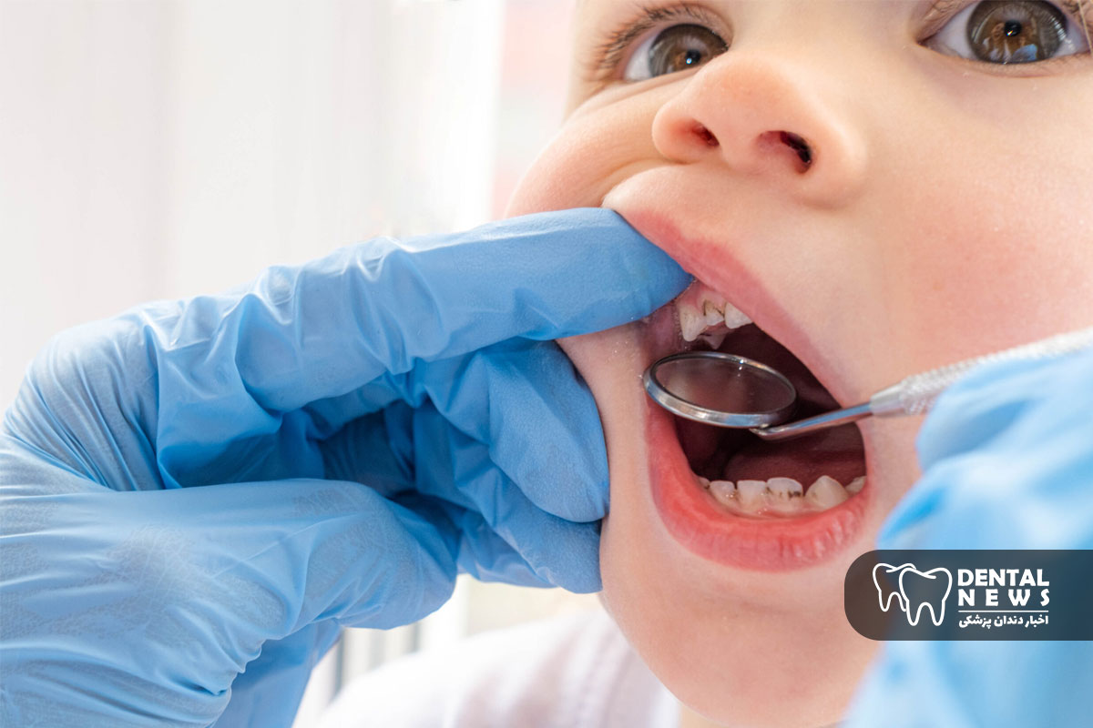 چرا دندان های شیری کودکان باید درمان شوند؟ پاسخ به یک دغدغه والدین