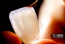 تفاوت لمینت سرامیکی و کامپوزیت ونیر در ماندگاری