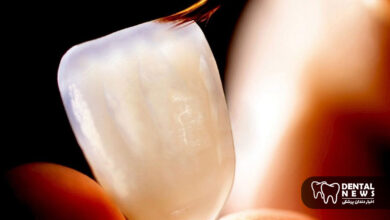 تفاوت لمینت سرامیکی و کامپوزیت ونیر در ماندگاری