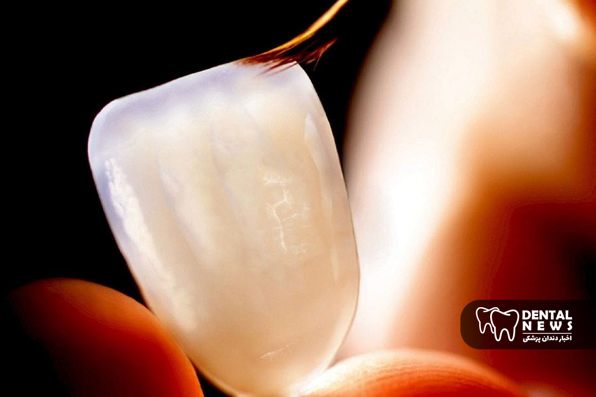 تفاوت لمینت سرامیکی و کامپوزیت ونیر در ماندگاری