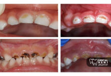 تاثیر قطره آهن بر دندان های کودک و 7 راهکار قطعی برای جلوگیری از سیاهی و لکه دار شدن دندان ها