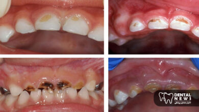 تاثیر قطره آهن بر دندان های کودک و 7 راهکار قطعی برای جلوگیری از سیاهی و لکه دار شدن دندان ها