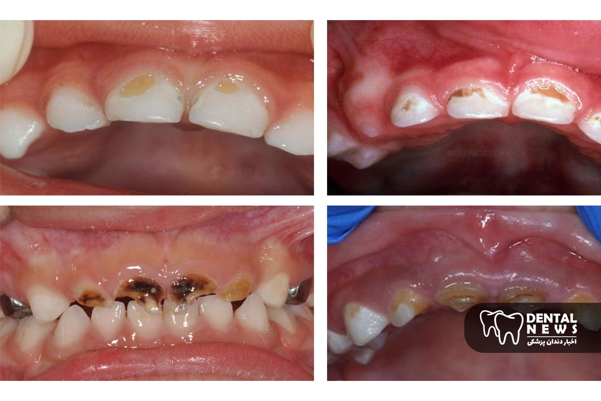 تاثیر قطره آهن بر دندان های کودک و 7 راهکار قطعی برای جلوگیری از سیاهی و لکه دار شدن دندان ها